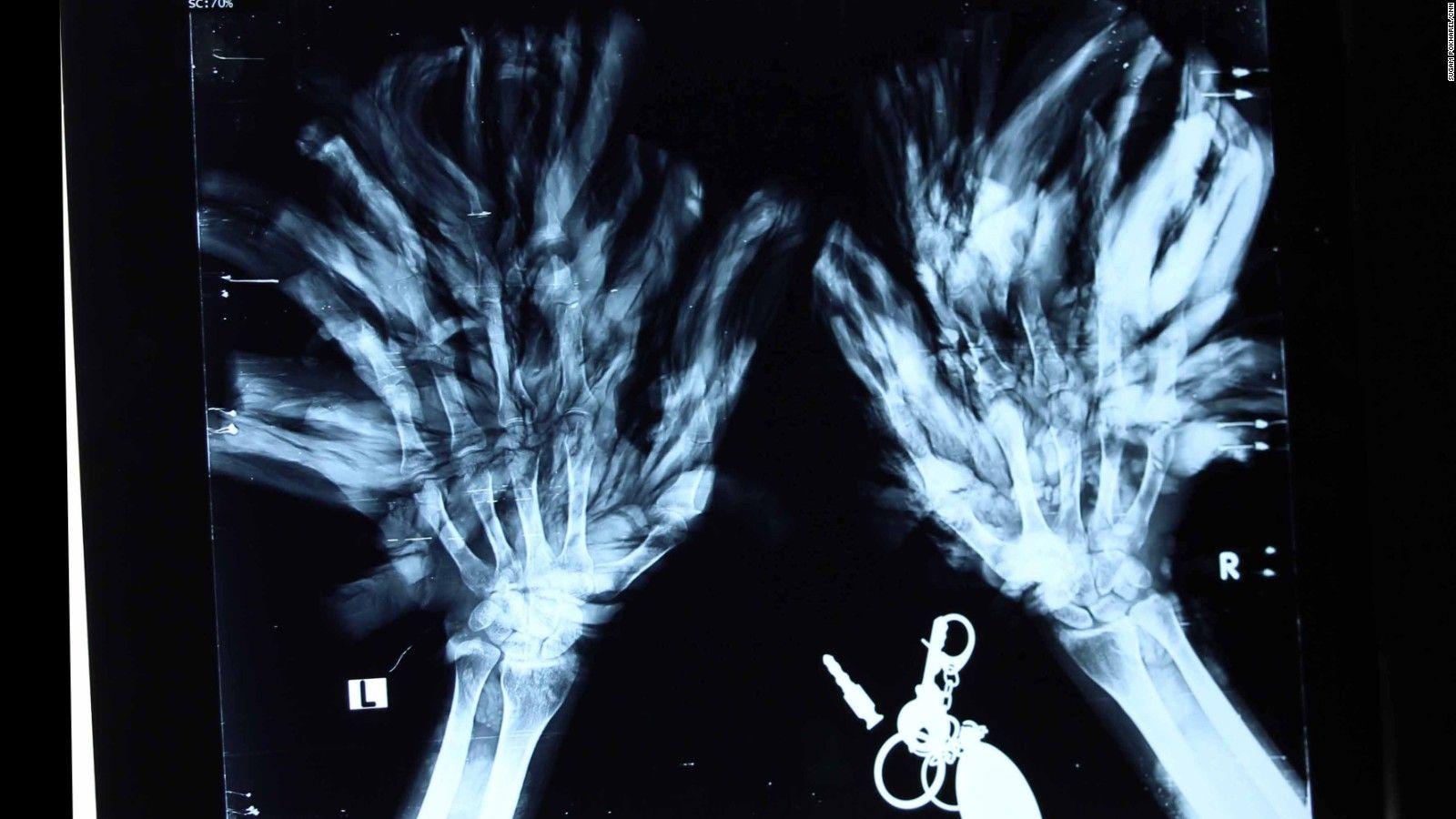 1600x900 Tree man': Bangladeshi man back in hospital and needs more surgery