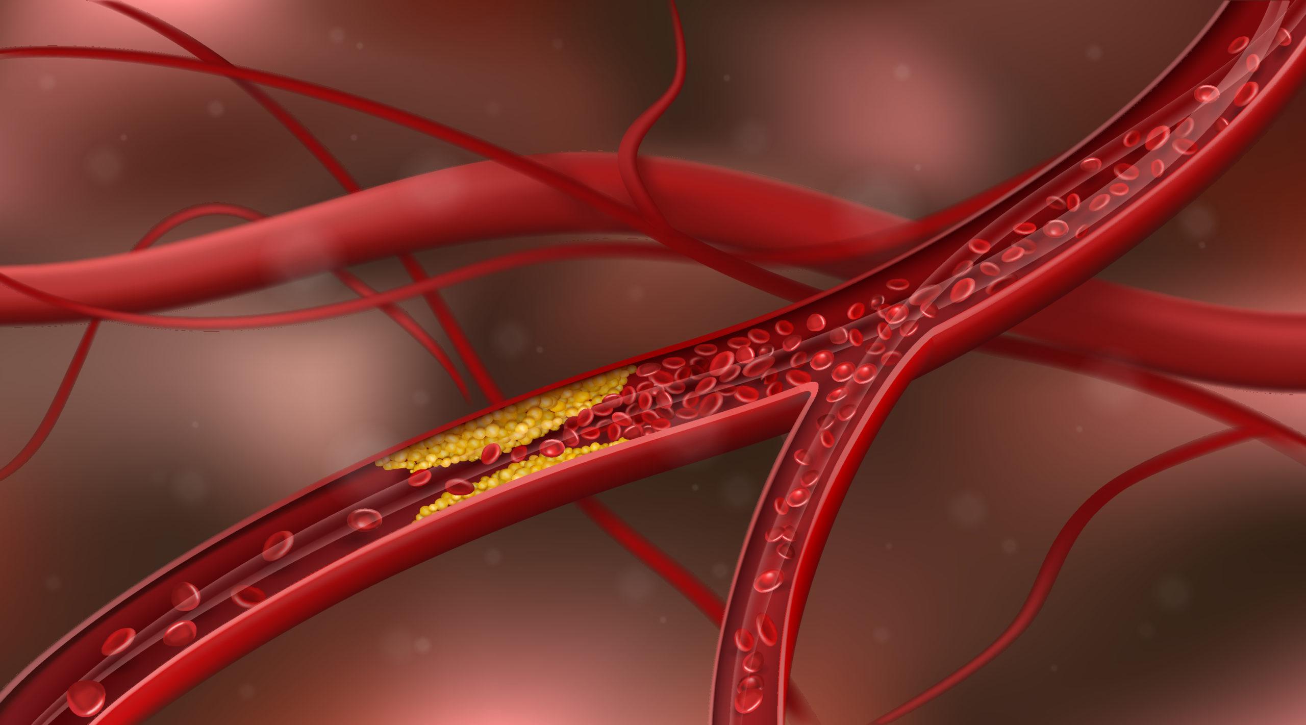 2560x1421 Peripheral Artery Disease: The Obesity