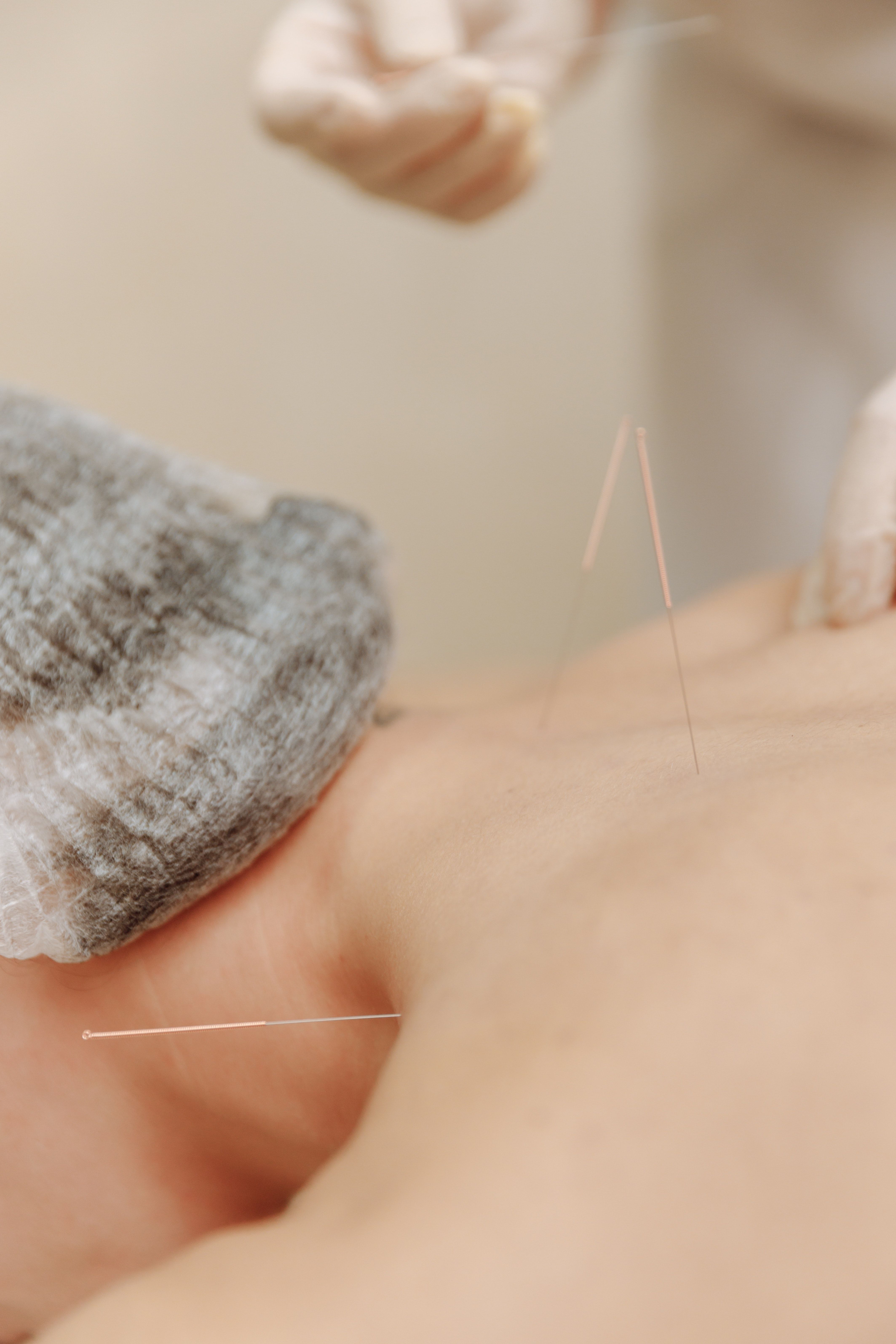 4254x6381 Acupuncture Photo, Download The BEST Free Acupuncture & HD Image
