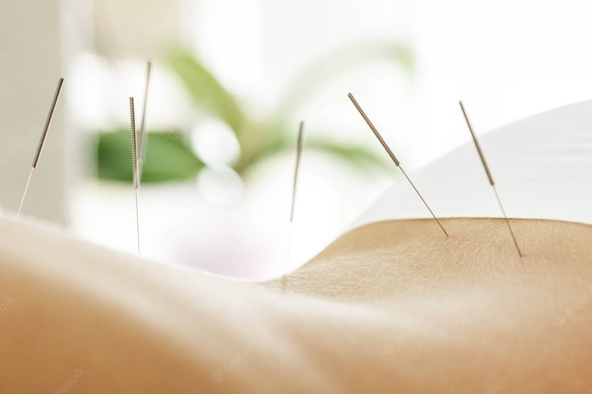 1920x1280 Download Caption: Experienced Acupuncturist performing back needle therapy Wallpaper