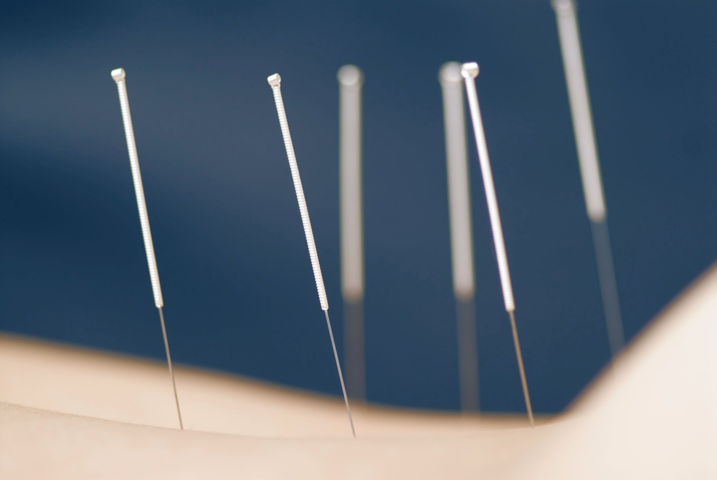 Acupuncture Wallpapers - Top Free Acupuncture Backgrounds - WallpaperAccess