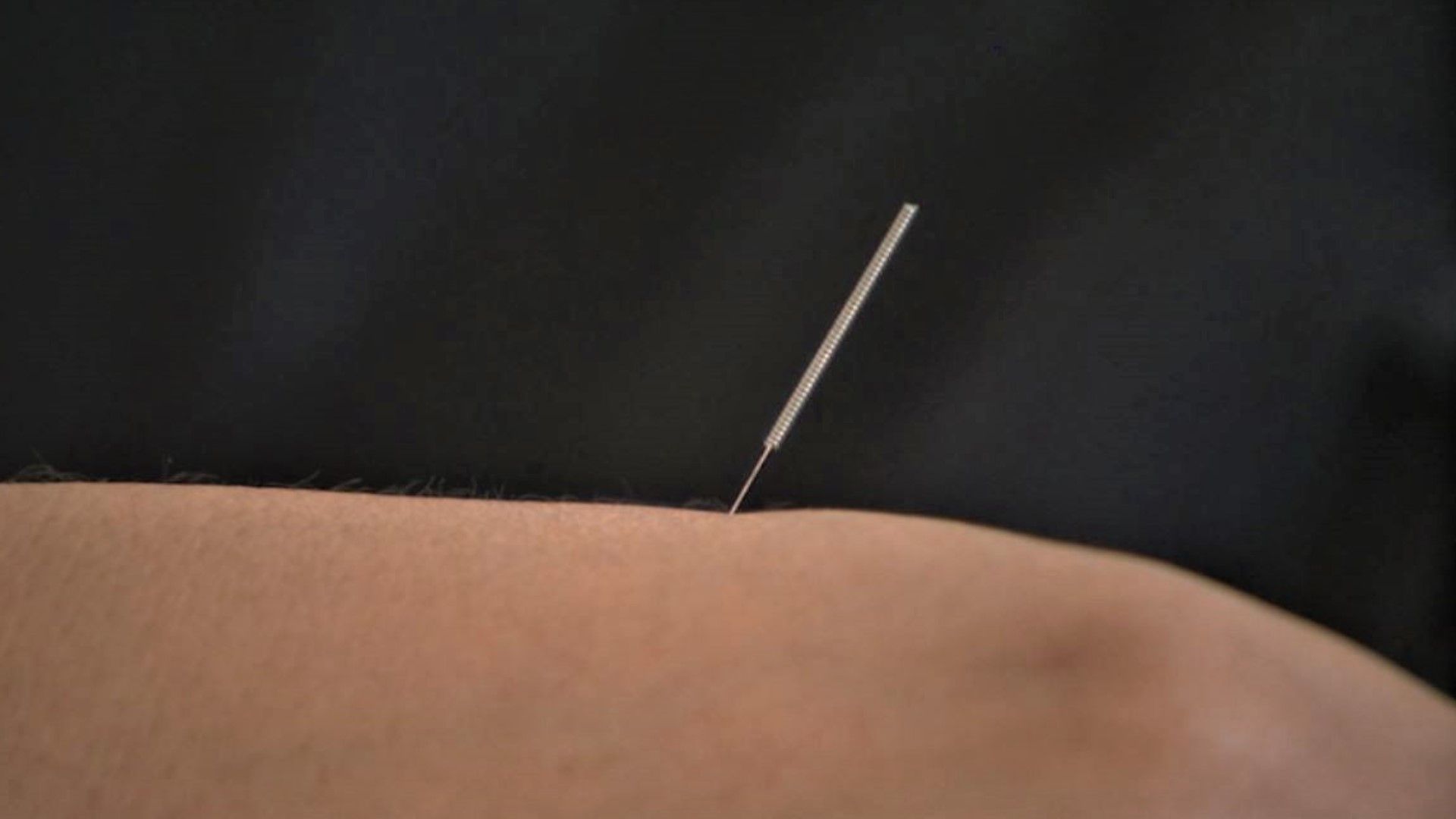 1920x1080 Team Evening tries acupuncture to relieve stress and anxiety