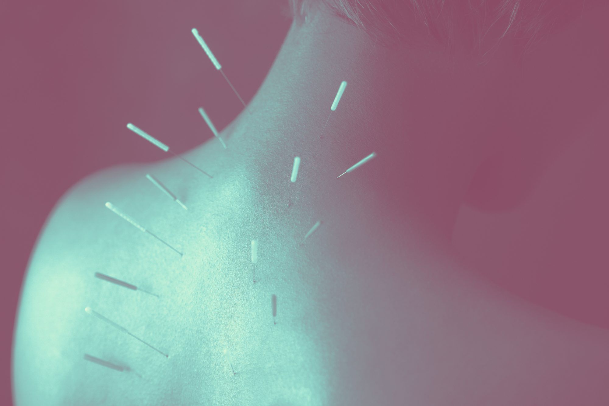 Acupuncture Wallpapers - Top Free Acupuncture Backgrounds - WallpaperAccess