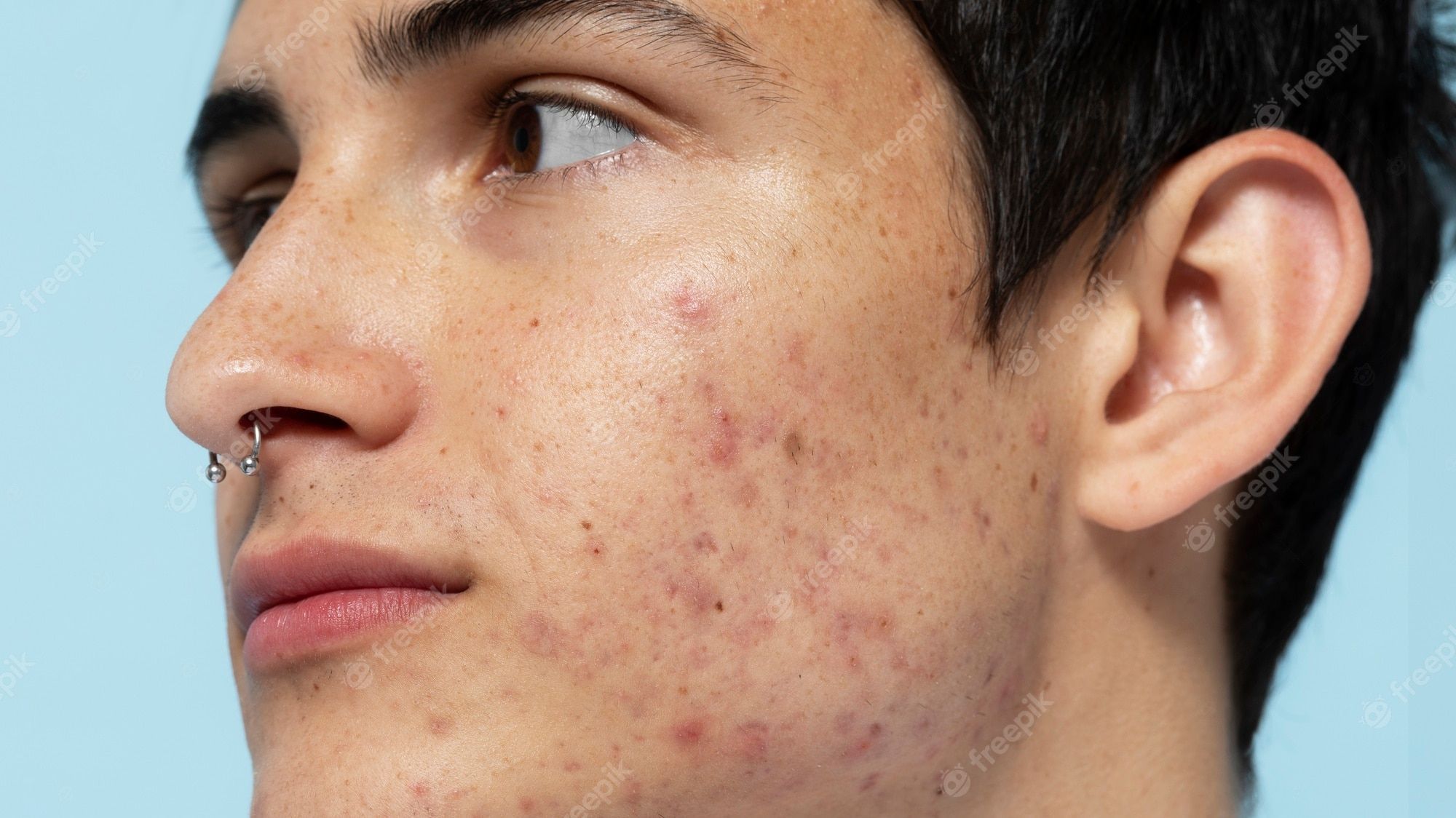 Pimple wallpapers top free pimple backgrounds wallpaperaccess