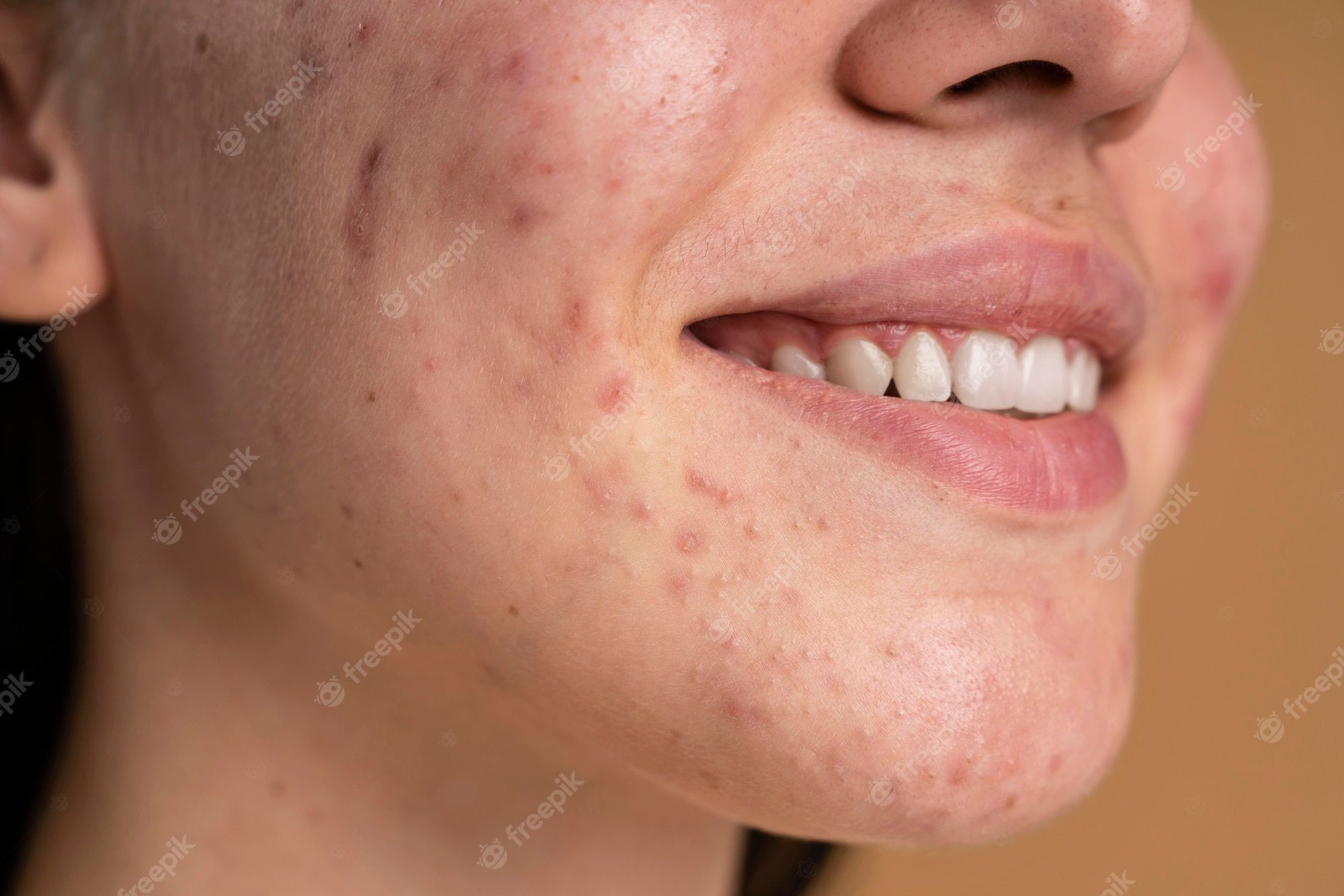 Pimple Wallpapers - Top Free Pimple Backgrounds - WallpaperAccess