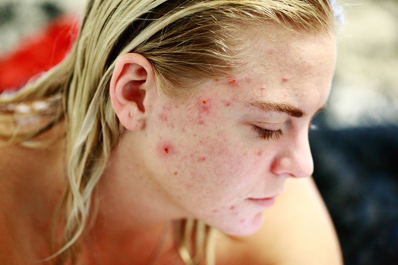 1280x853 Free Acne & Dermatology Image