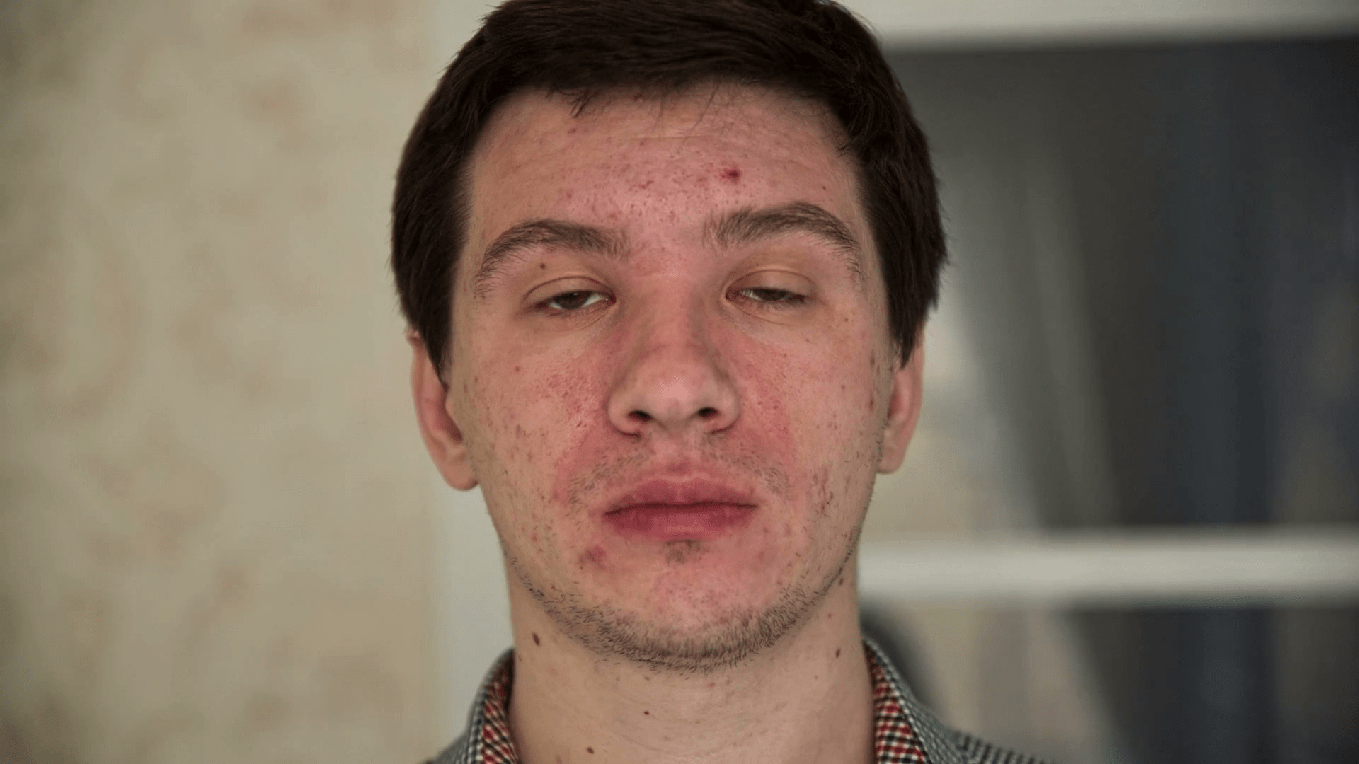1920x1080 Man With Acne Problem Skin Stock Footage SBV 306919570
