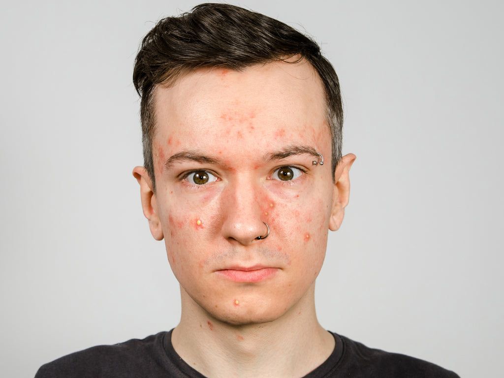 1024x768 What Skin Infection Looks Like Acne?