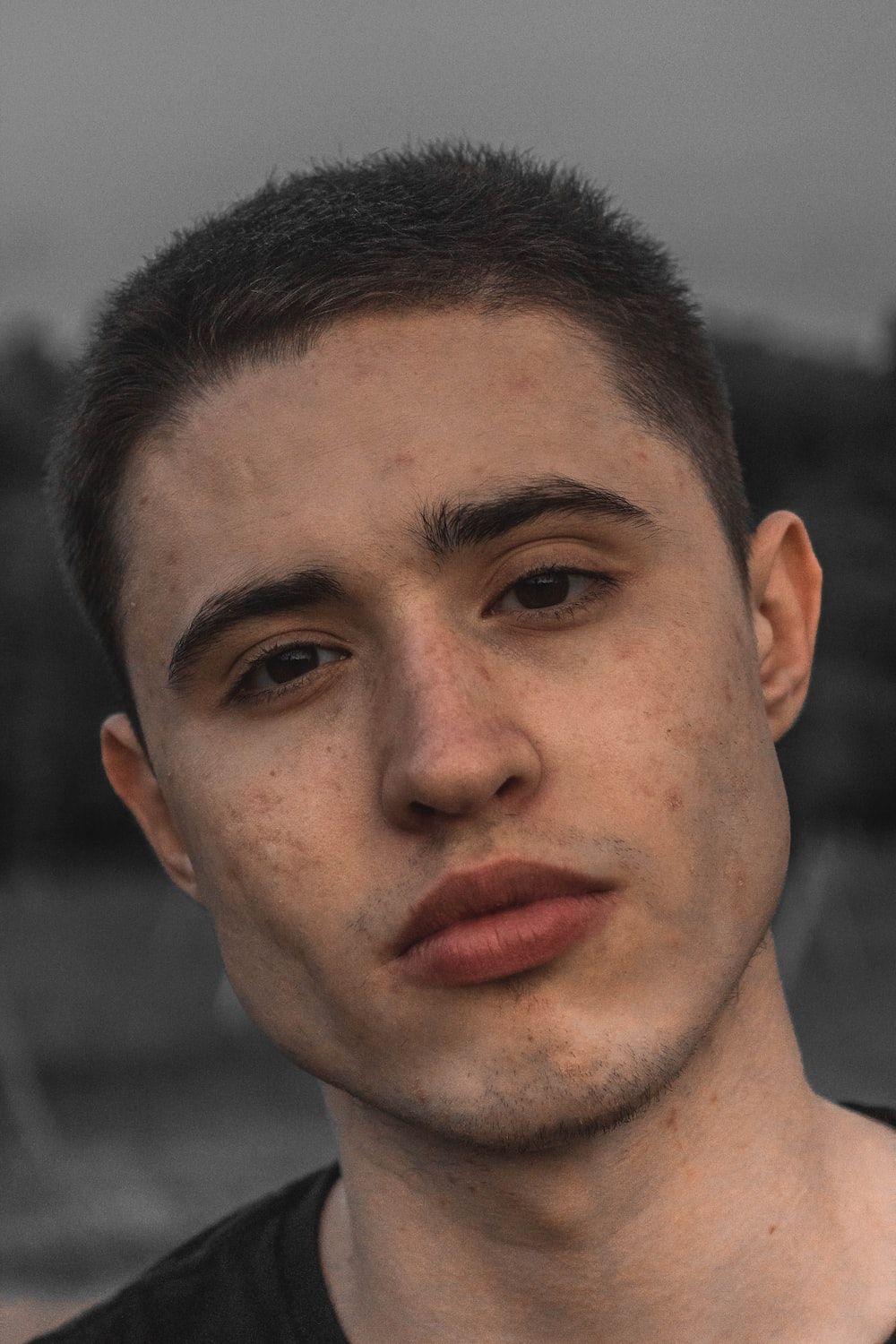 1000x1500 Acne Picture. Download Free Image