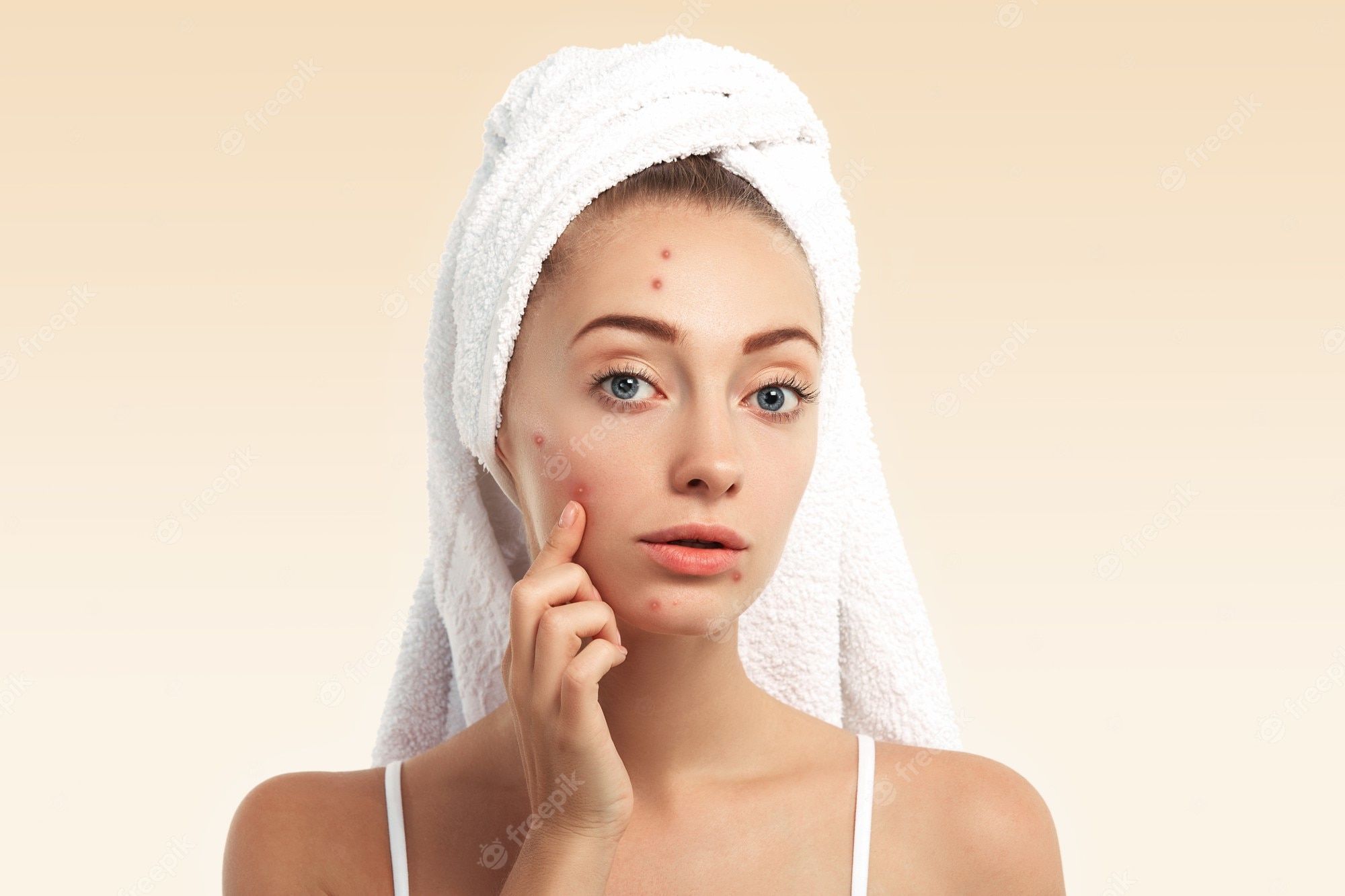 2000x1333 Pimple Face Image