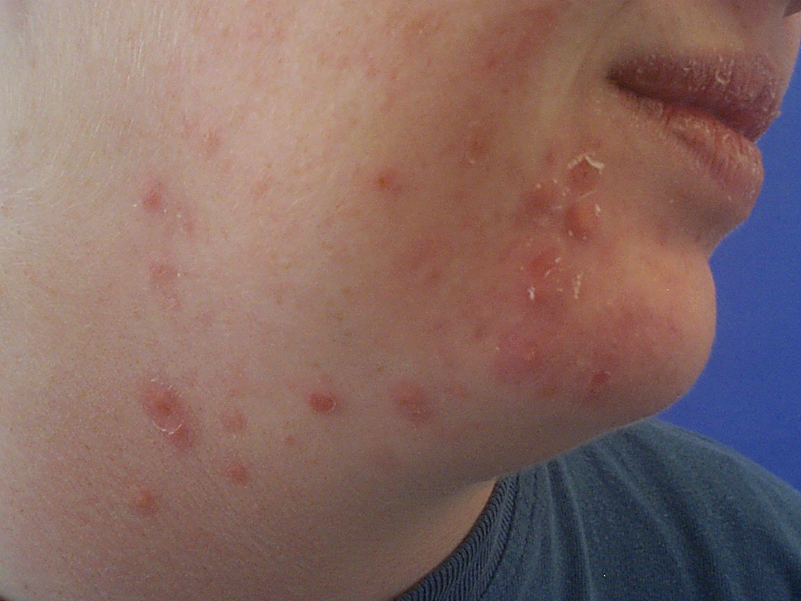 1152x864 Acne Papules Causes and Treatments