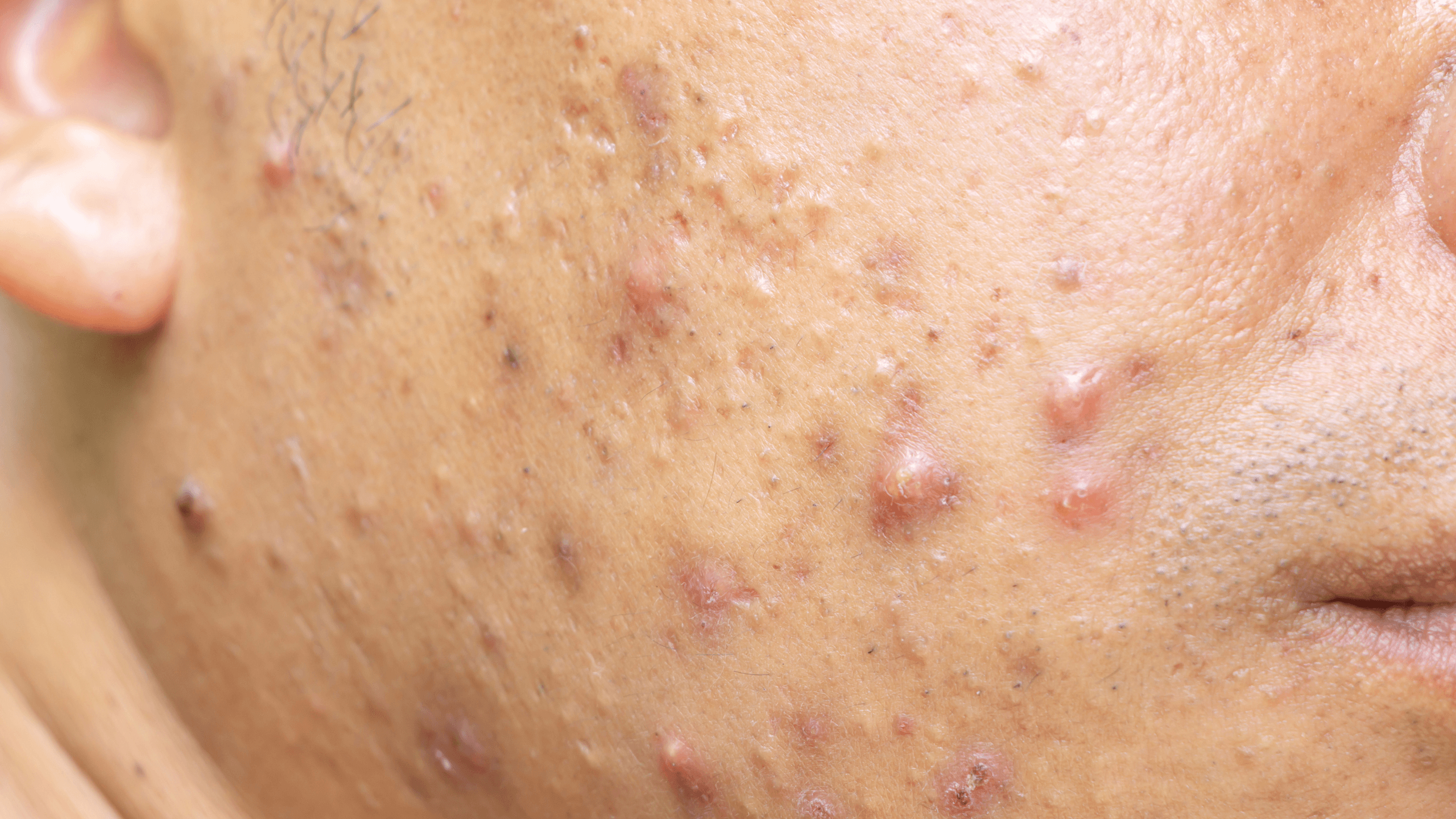 2560x1440 Types of Acne: Cystic Acne