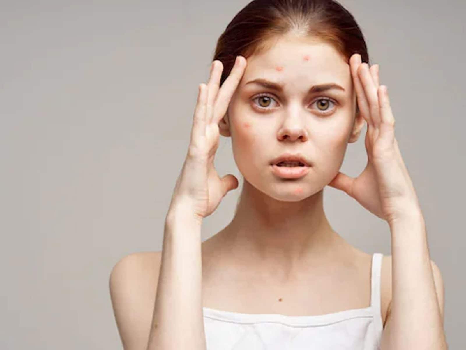 1600x1200 Bothered by Acne And Pimples? Bring These Lifestyle Changes for Glowing Skin